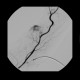 Neovascularisation in tumour of biceps brachii: AG - Angiography